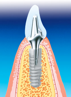 Bild mit freundlicher Genehmigung der Dentsply DeTrey GmbH.